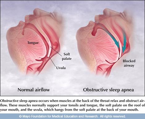 Sleep Apnea | Health Style Dental